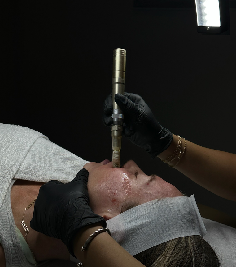 Microneedling